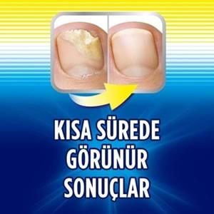 Scholl Tırnak Mantar Tedavisi Mantar Giderici